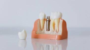 Who Is A Candidate For Dental Implants